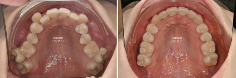 인비절라인 비발치 제2대구치 발치 사랑니 대체 교정 심한 덧니 교정 치료 관련 이미지 19