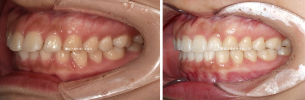 돌출입 교정 치아 벌어짐 인비절라인 투명교정 치료 관련 이미지 9