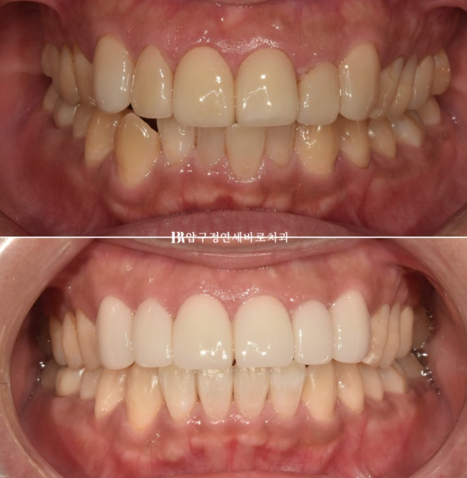 40대 중년 치아교정 인비절라인 라이트 치료기간 8개월 관련 이미지 1