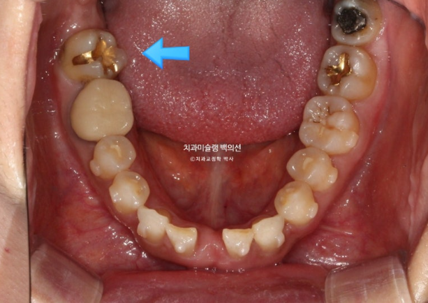 해외거주 앞니 선천적 결손 과개교합 인비절라인 라이트 브릿지 치료 관련 이미지 9