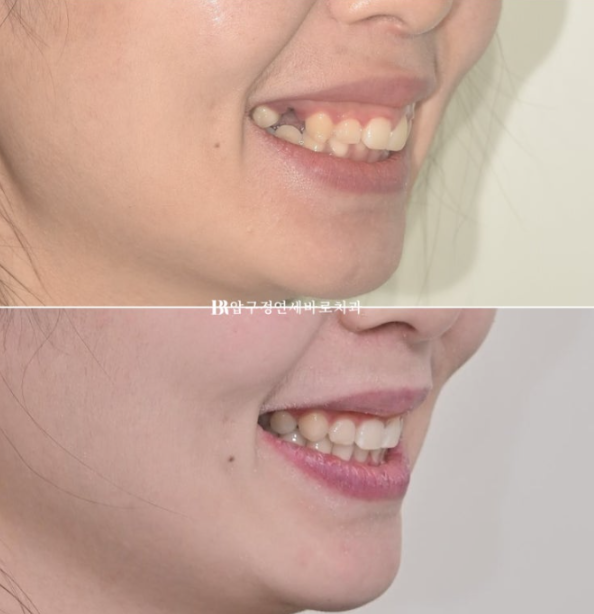Can't Invisalign Move the Roots? An Actual Case of Extraction Treatment for Protruding Mouth at a Gangnam Orthodontic Clinic image 14