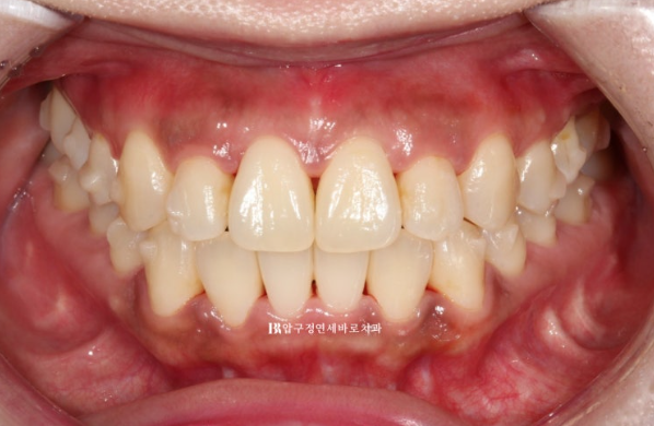Is compliance important for Invisalign? | A real case that improved reverse bite and scissors bite in 8 months image 6