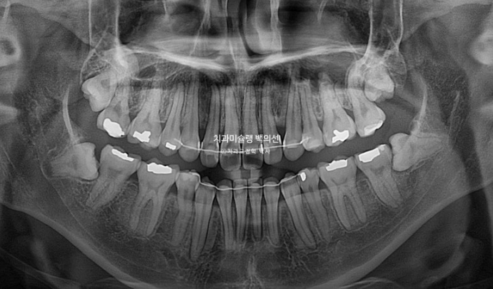 돌출입 인비절라인 발치교정 거미스마일 잇몸미소 잇몸돌출 입술부전증 무턱 재교정 관련 이미지 25