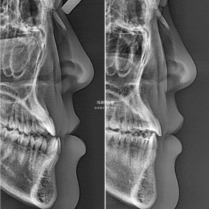 비수술 비발치 주걱턱 절충치료 클리피씨 개방교합 반대교합 치료 관련 이미지 20