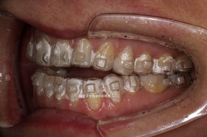 50대 인비절라인 개방교합 합입교정 미니스크류 관련 이미지 10
