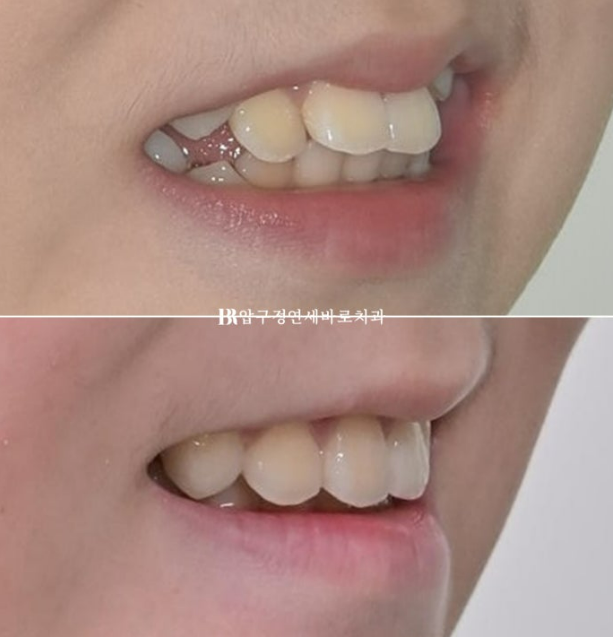 인비절라인 퍼스트, 결국 다시 교정해야 할까? 관련 이미지 18