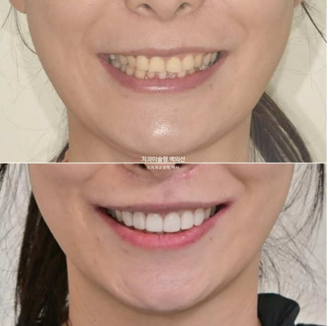 비발치 덧니 교정 인비절라인 과개교합 교정 무삭제 라미네이트 치료 후기 관련 이미지 22
