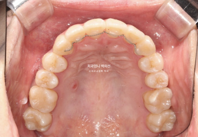 비발치 교정 덧니 인비절라인 교정 절단교합 반대교합 치료기간 1년 6개월 관련 이미지 18