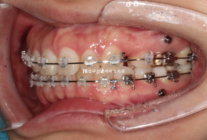 Gummy Smile Correction, Gummy Smile Orthodontics, Rabbit Teeth Correction image 7
