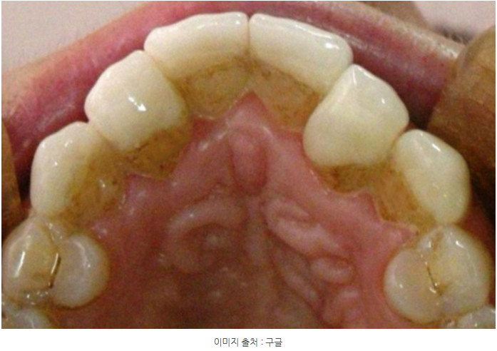 무삭제 라미네이트 아무곳에서 하지 마세요. 관련 이미지 2