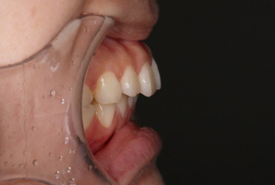 Gummy Smile Correction Review | Natural Improvement of Gummy Smile and Buccal Corridors Through Extraction Treatment for Protruding Teeth image 3