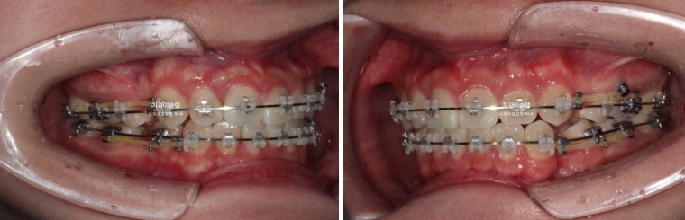 잇몸미소 거미스마일 치료 옥니 교정 잇몸성형 후기 관련 이미지 9