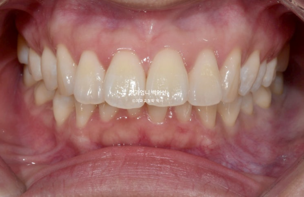 돌출입 교정 인비절라인 발치 교정 후기 관련 이미지 2