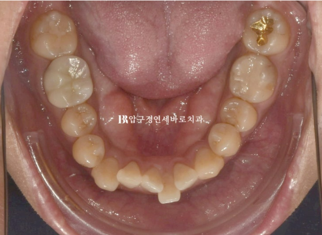 40대 치아교정 인비절라인 라이트 덧니 교정 어금니 교합 부작용 관련 이미지 5
