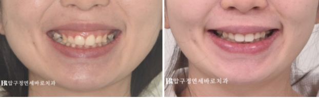 웃을 때 잇몸이 많이 보인다면? 거미스마일 원인과 교정 방법 관련 이미지 8