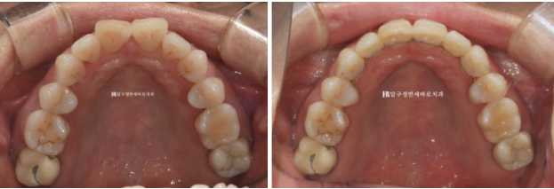 50대 중년교정 인비절라인 라이트 나비치아 교정 앞니 교정 후기 관련 이미지 11
