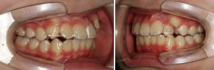 덧니 인비절라인 교정 :: 강남 인비절라인 교정치과 관련 이미지 3
