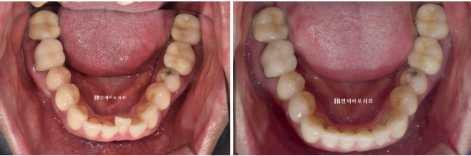 안보이는 앞니 교정 2D 교정 부분교정 후기 / 교정 시 잇몸이 더 나빠지지 않을까요? 관련 이미지 8