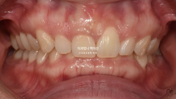 거미스마일 과개교합 교정 잇몸돌출 잇몸 비대칭 관련 이미지 2