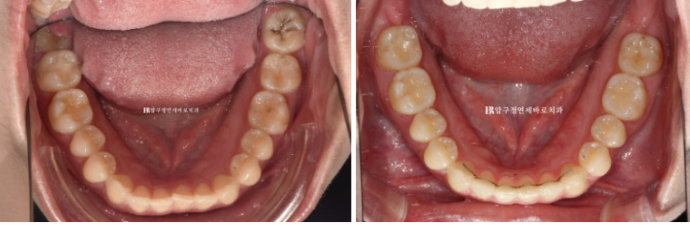 압구정 교정치과 / 옥니교정 인비절라인 라이트 덧니교정 관련 이미지 14