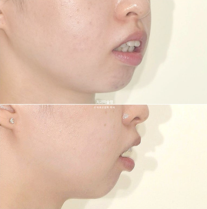 심한 돌출입 입술부전증 호두주름 발치교정 치료 관련 이미지 6