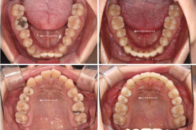 Invisalign Success Depends on Wearing Them Consistently|9-Month Real Treatment Case of Crowding & Underbite image 12