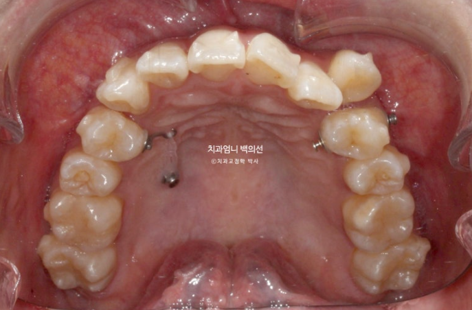 비발치 교정 덧니 인비절라인 교정 절단교합 반대교합 치료기간 1년 6개월 관련 이미지 10