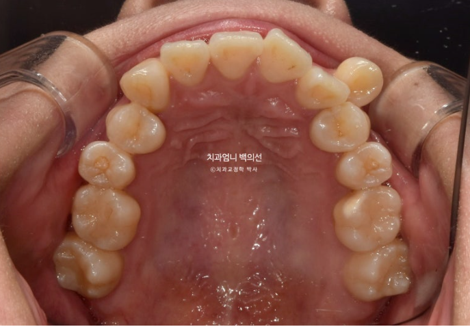 비발치 교정 덧니 인비절라인 교정 절단교합 반대교합 치료기간 1년 6개월 관련 이미지 4