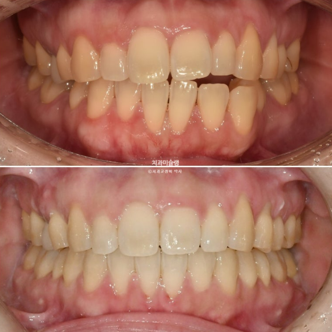 비발치 인비절라인 교정 편측 개방교합 가위교합 돌출 재교정 관련 이미지 1