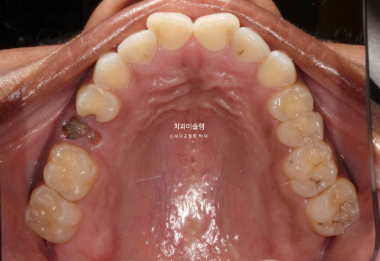 Extraction & re-orthodontics with Clippy-C, intrusion for dental implant. 관련 이미지 3