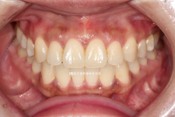 Invisalign Success Depends on Wearing Them Consistently|9-Month Real Treatment Case of Crowding & Underbite image 10