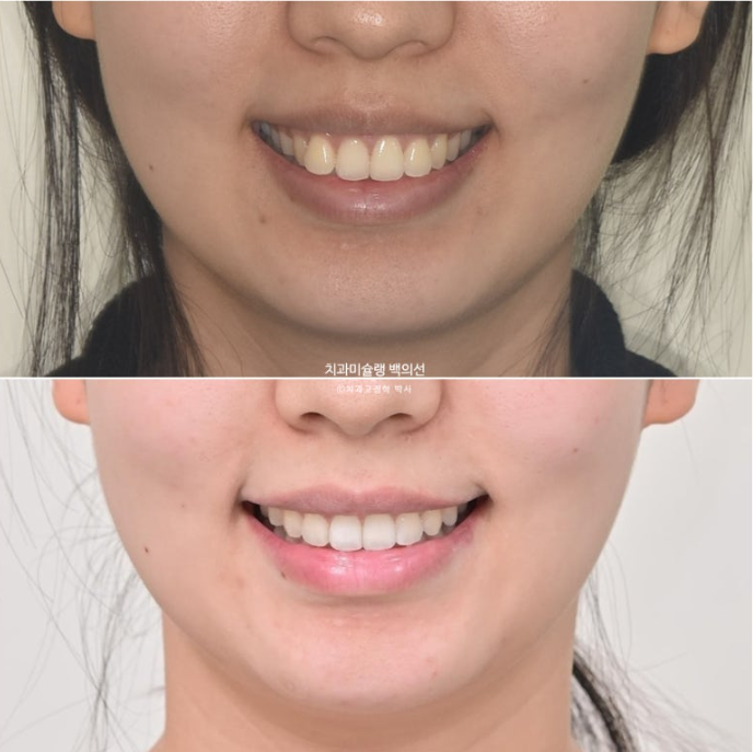 비발치 인비절라인 교정 돌출입 교정 후기 관련 이미지 20