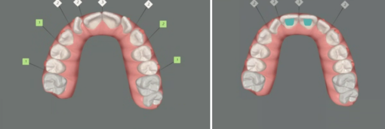 서울 인비절라인 덧니 교정 과개교합 후기 관련 이미지 5