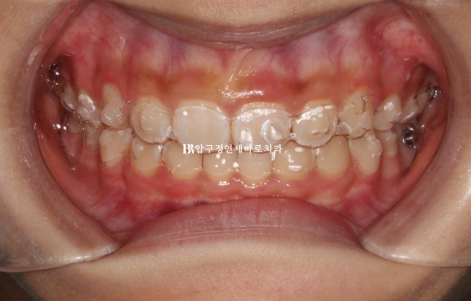 Pediatric Clear Aligners That Improved Both Deep Bite and Protruding Teeth image 9