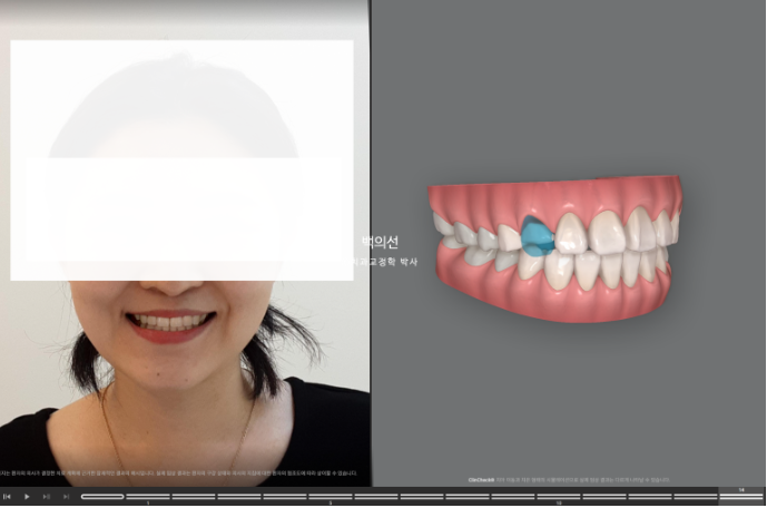 매복 결손 잔존유치 라미네이트 크라운 캔팅 인비절라인 라이트 치료 관련 이미지 7