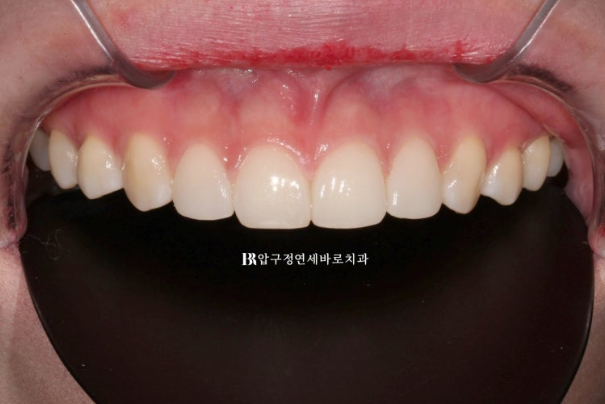 왜소치 원추형 치아 무삭제 라미네이트 앞니 4개 관련 이미지 7