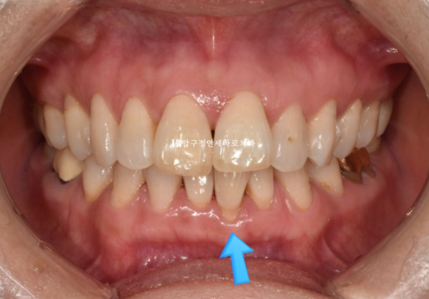Can Invisalign Lite Work for People in Their 50s? A Real Middle-Aged Orthodontic Case Improving Butterfly Teeth and Gum Recession image 3