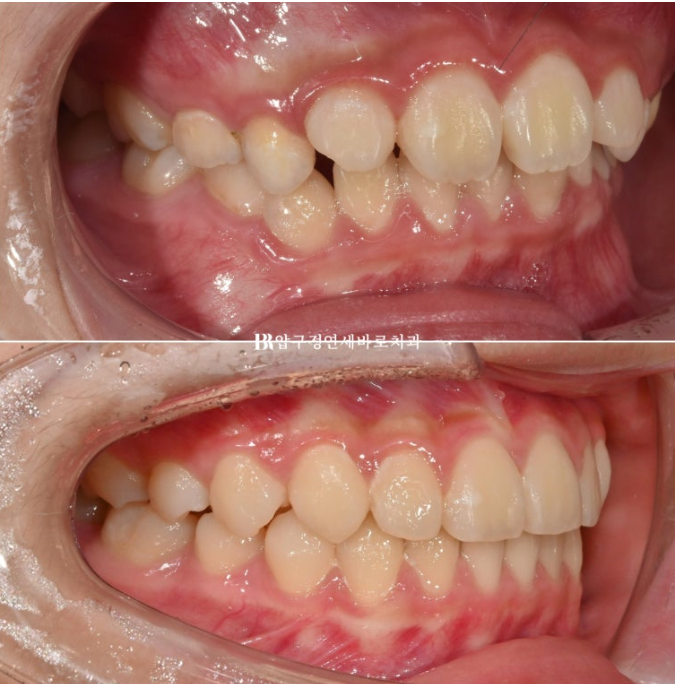 어린이교정 투명교정 인비절라인 퍼스트 후기 관련 이미지 15