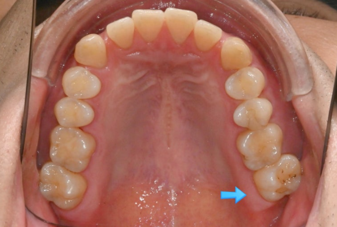 가위교합 벌어짐 중심선 과개교합 인비절라인 라이트 교정 관련 이미지 5