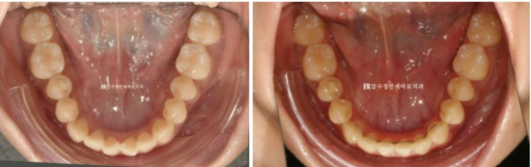 인비절라인 익스프레스 토끼이빨 앞니교정 ? 관련 이미지 14