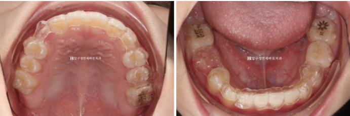 Simultaneous Arch Expansion and Teeth Alignment for Elementary School Children with Invisalign｜Invisalign First image 7