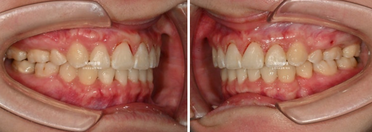 잇몸미소 거미스마일 치료 옥니 교정 잇몸성형 후기 관련 이미지 14