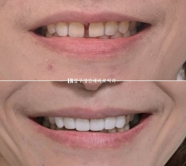 벌어진 치아 교정 인비절라인 라이트 무삭제 라미네이트 치료 관련 이미지 23