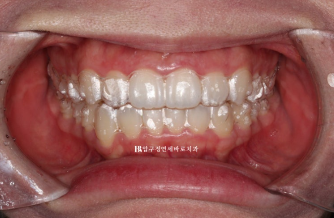 인비절라인 라이트 과개교합 반대교합 돌출입 뻐드렁니 교정 치료 관련 이미지 5
