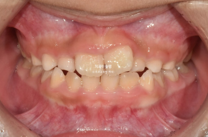 7세 어린이 반대교합 부정교합 프리올소 치료 관련 이미지 5