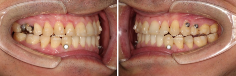 40대 인비절라인 비수술 비발치 주걱턱 비대칭 교정 관련 이미지 8