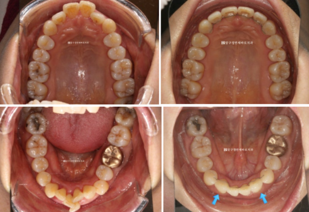 40대 치아교정 가능할까요? 치주염 있어도 치아교정 가능할까요? 임플란트 없이 교정하기 관련 이미지 10