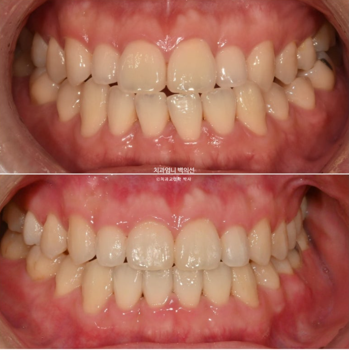 주걱턱 교정 반대교합 소구치 선천적 결손 부정교합 비발치 교정 후기 관련 이미지 13