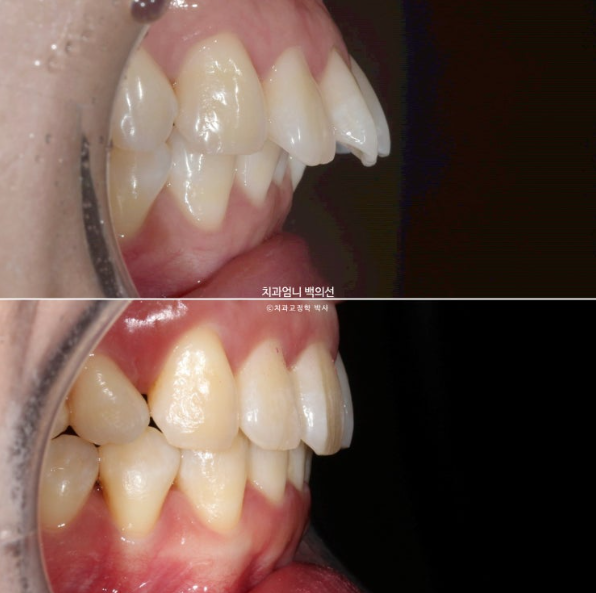 돌출입 교정 인비절라인 발치 교정 후기 관련 이미지 18