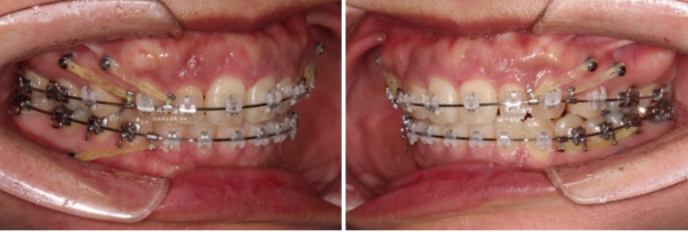 Extraction Orthodontics with Clippy-C for Protruding Mouth, Gum Smile, Gummy Smile Correction, and Treatment for a Recessed Chin image 6